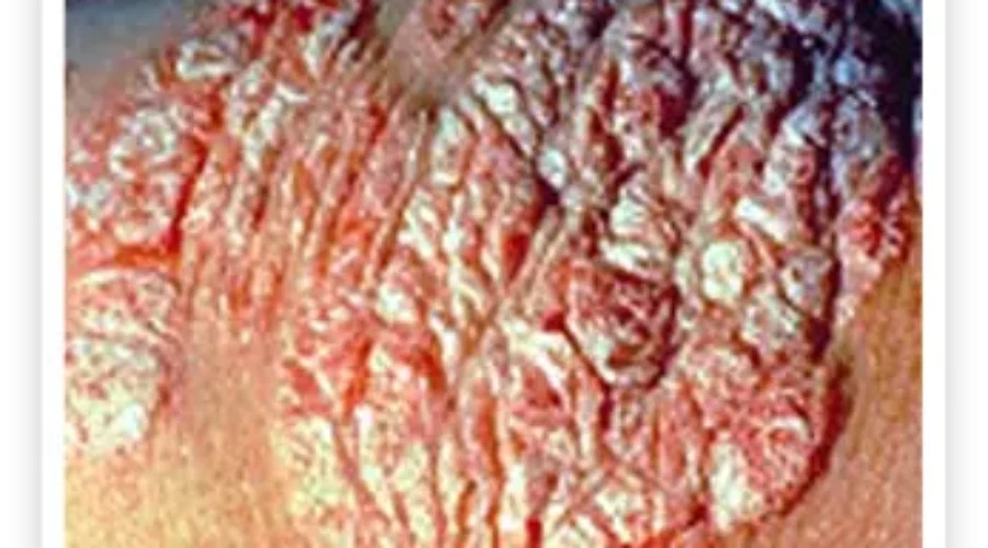 Psoriasis Affecting More Than Just Skin