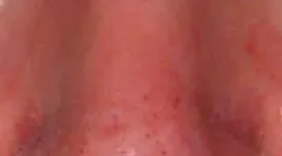 Why Does My Nose Itch?