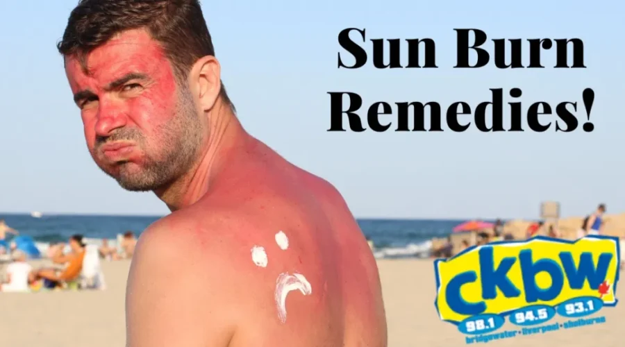 Sunburns! What’s Your Remedy?