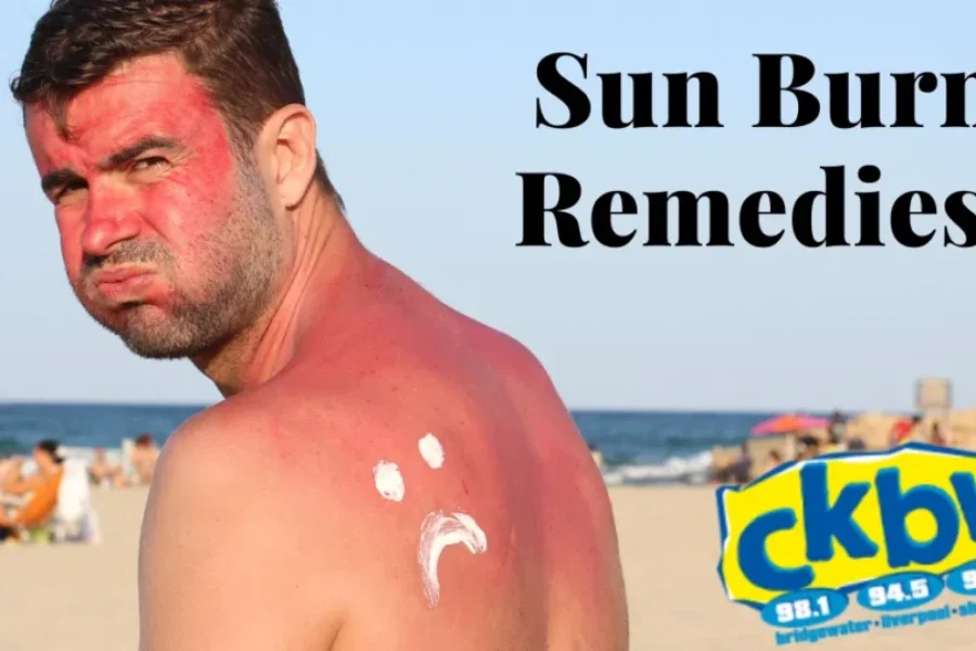 Sunburns! What’s Your Remedy?