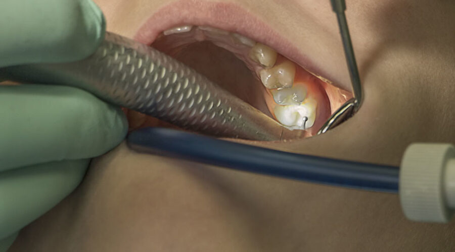 Fluoride in water is crucial for public health, says dentist