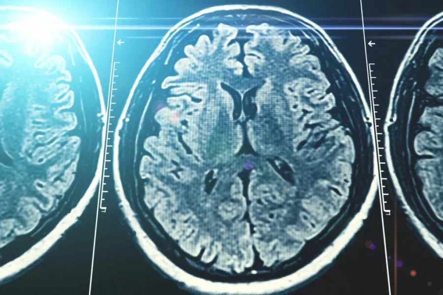Stigma keeps many Canadians from seeking dementia help