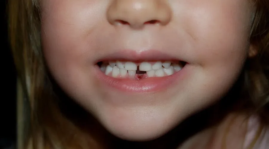 Lost A Tooth? Looks Like You Are In The $$